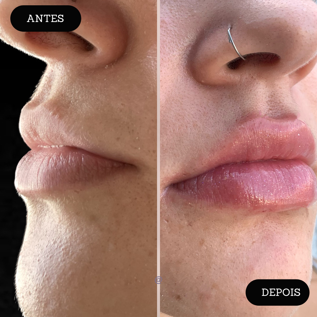 ANTES E DEPOIS UNHAS